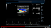 УЗИ аппарат Mindray DC-80 Общие исследования