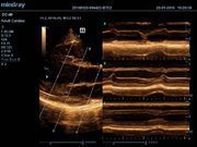 УЗИ аппарат Mindray DC-40 Общие исследования